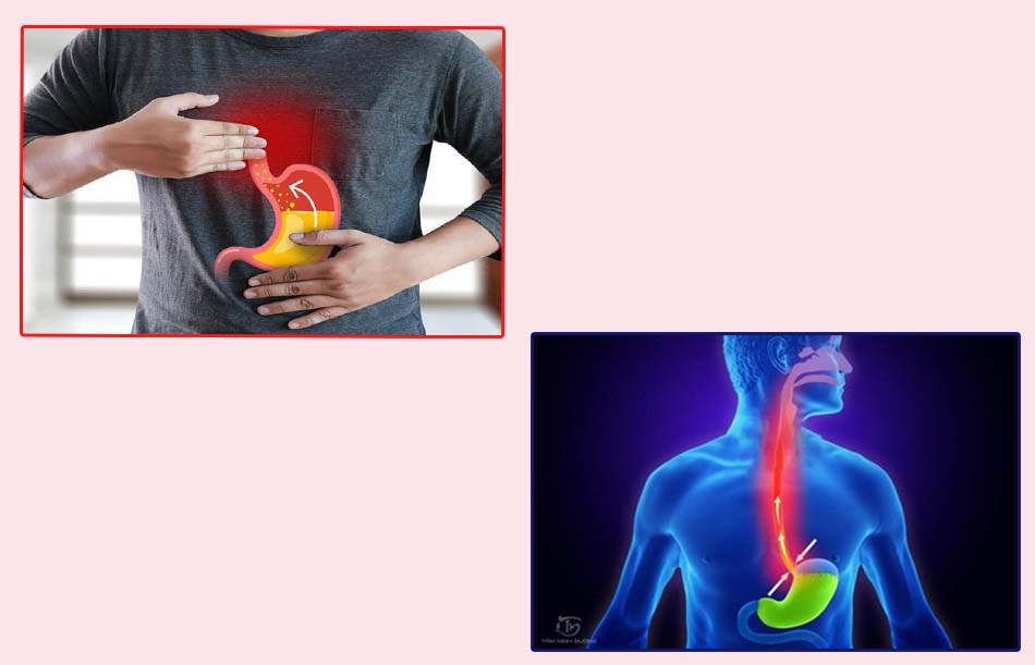 Hình ảnh: Bệnh nhân bị trào ngược dạ dày thực quản