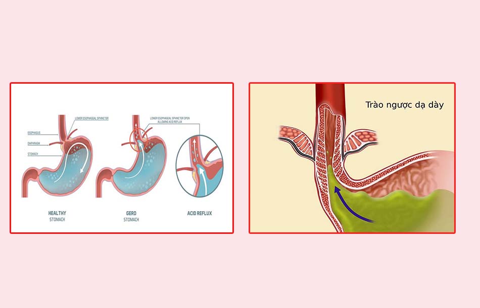 Hình ảnh: Bệnh nhân bị trào ngược dạ dày thực quản