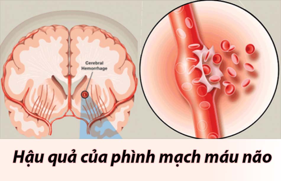 Hậu quả phình mạch máu não