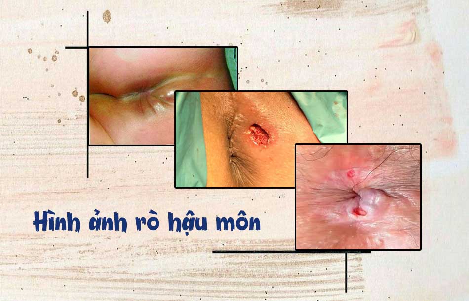 Hình ảnh một số bệnh nhân bị rò hậu môn