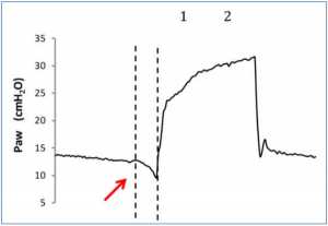 Hình 1: Độ lệch âm của sóng áp lực do nỗ lực hô hấp của bệnh nhân (mũi tên màu đỏ). Hai đường chấm chấm biểu thị sự khởi đầu của nỗ lực hô hấp của bệnh nhân (1) và sự hỗ trợ thở máy chậm (độ trễ hít vào) (2).