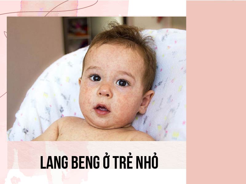 Bệnh lang beng ở trẻ nhỏ có thể do nhiều nguyên nhân