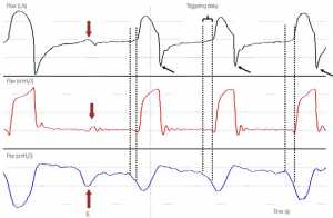 Hình 2. Đường cong áp lực đường thở (Paw), lưu lượng và áp lực thực quản (Pes) ở bệnh nhân được thở máy với thông khí hỗ trợ áp lực.