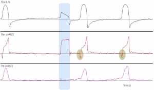 Hình 4. Áp lực đường thở (Paw), lưu lượng và áp lực xuyên cơ hoành (Pdi) của bệnh nhân thở máy thông khí hỗ trợ áp lực được minh họa.