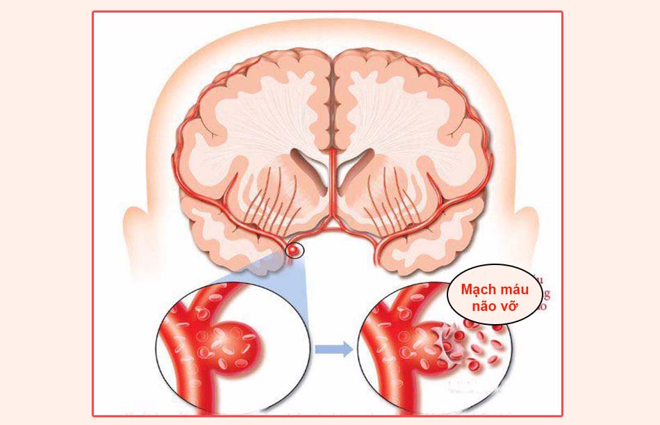 Mạch máu não vỡ ra là nguyên nhân gây xuất huyết não