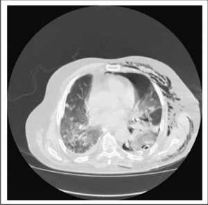 Hình 11.1 CT scan của bệnh nhân biểu hiện ARDS sau mở lồng ngực cắt thùy trên phổi trái. Khoảng trống là nơi nhu mô phổi đã cắt đi, vùng xẹp phổi ở phần nhu mô phổi còn lại, thâm nhiễm cả 2 bên phổi mà không có bất kỳ dấu hiệu nào của nhiễm trùng, và có tràn khí dưới da.