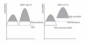 Hình 11.2 Liên quan giữa FRC (functional residual capacity) và CC (closing capacity) ở các cách cài đặt thông số thở máy khác nhau. Bên phải: FRC nằm dưới CC trong khi thở máy; thể tích khí lưu thông lớn có thể có trao đổi khí tốt hơn (diện tích vùng nằm trên đường CC); tuy nhiên việc đóng mở chu kỳ phế nang không thể tránh khỏi. Bên trái: áp dụng PEEP trong khi giữ VT thấp: PEEP làm cho FRC nằm trên CC. Đóng mở phế nang chu kỳ tránh được; và việc thông khí (bây giờ nằm trên FRC “mới”) vẫn tốt hơn là không có PEEP (Adapted from [17] (with permission))