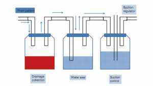 Hình 1.6 Hệ thống dẫn lưu 3 bình. Bình đầu tiên (drainage collection) có thể làm tăng kháng lực với dẫn lưu nếu mức dịch/máu dâng lên cao trong bình. Thêm bình thứ hai (water seal) cho phép dịch dẫn lưu chứa trong bình thứ nhất và khí đi qua bình thứ hai, cũng ngăn ngửa tạo thành bọt khí. Tuy nhiên tăng thêm chiều dài ống có thể làm tăng khoảng chết và kháng lực thêm nữa, có thể làm dịch đi ngược lại ống và có thể vài lại khoang màng phổi. Vì vậy bình thứ ba (suction control) cho phép hút áp lực âm chủ động, ngăn dịch từ bình đi ngược vào bệnh nhân (Adapted from [40] (with permission))