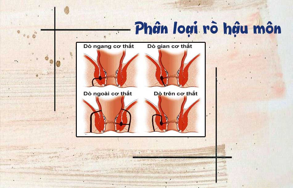 Phân loại rò hậu môn