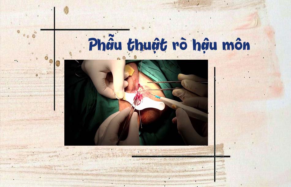 Điều trị rò hậu môn bằng phẫu thuật