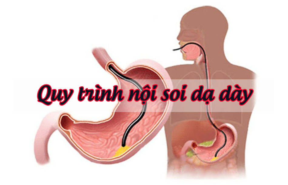 Quy trình nội soi dạ dày