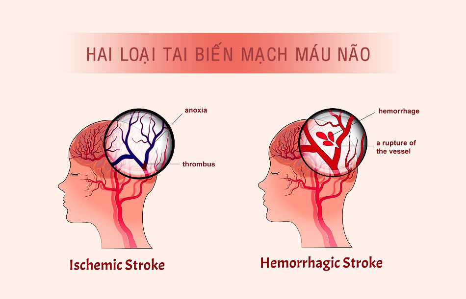 Phân loại tai biến mạch máu não