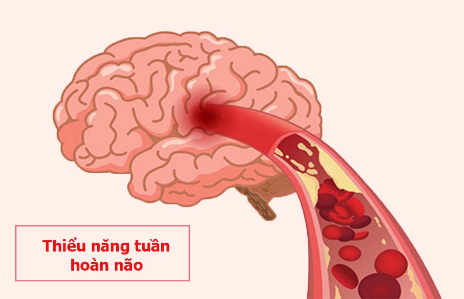 Thiểu năng tuần hoàn não là bệnh gì?