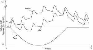 Hình 1 Ảnh hưởng của thông khí dao động tần số cao không xâm lấn (NHFOV) trong quá trình thở tự nhiên lên áp lực và thể tích trong mô hình sơ sinh.