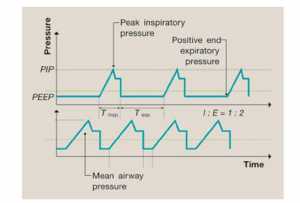 Hình 1. Mối quan hệ giữa MAP, PIP, PEEP, Ti và tỷ lệ I:E.