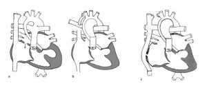 Hình 10: Hội chứng thiểu sản tim trái: a) trước khi được phẫu thuật, b) sau phẫu thuật Norwood 1 và c) sau phẫu thuật Fontan