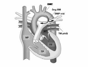 Hình 13: Còn ống động mạch với shunt trái-phải.