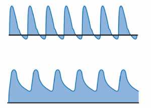Hình 14: Hình ảnh phổ Doppler của động mạch não trước trước (hình trên) và sau (hình dưới) ống động mạch được đóng bằng thuốc.
