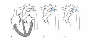 Hình 2: Hẹp eo động mạch chủ: a) hẹp trước ống, b) hẹp cạnh ống và c) hẹp sau ống.