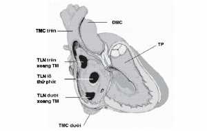 Hình 3: Thông liên nhĩ với các vị trí lỗ thông khác nhau