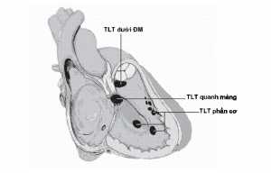 Hình 4: Thông liên thất với các vị trí lỗ thông khác nhau.