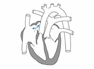 Hình 6: Chuyển vị đại động mạch kèm thông liên nhĩ.