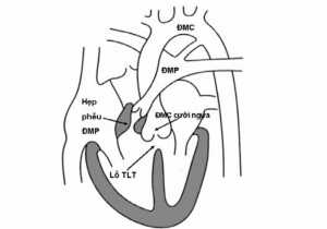 Hình 7: Tứ chứng Fallot.