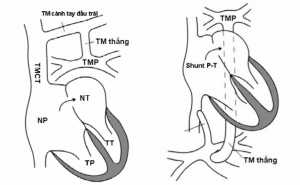 Hình 8: Bất thường hồi lưu TM phổi hoàn toàn a) thể trên tim và b) thể dưới cơ hoành.