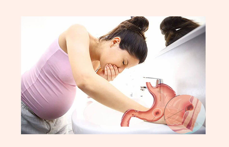 Triệu chứng của đau dạ dày khi mang thai