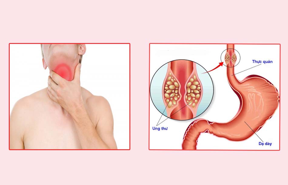 Trào ngược dạ dày thực quản có thể gây ung thư thực quản