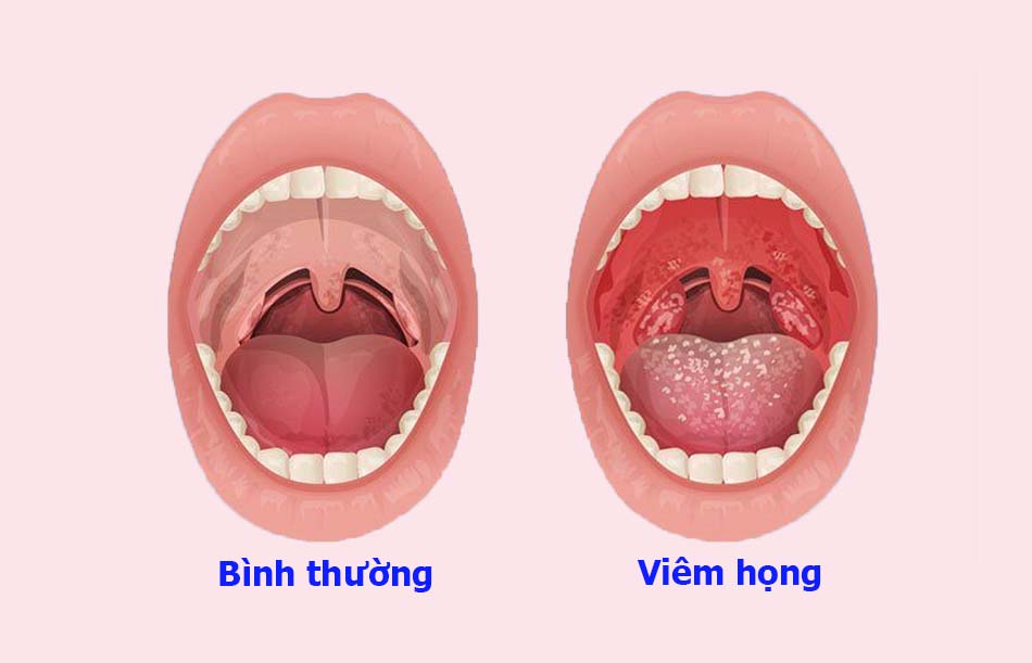 Viêm họng kéo dài có thể dẫn đến viêm họng hạt có mủ