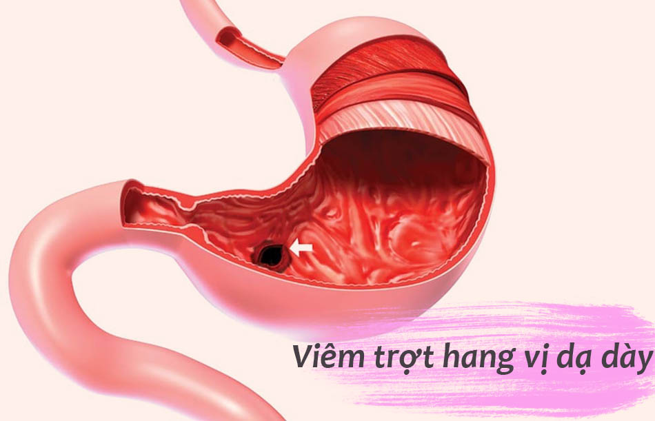 Chế độ ăn uống không khoa học là nguyên nhân dẫn đến viêm trợt hang vị dạ dày