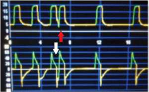 Hình 3: Mũi tên màu đỏ cho thấy “double-triggering” trên biểu đồ pressure-time. Mũi tên màu trắng chỉ “double-triggering” trên biểu đồ flow-time.