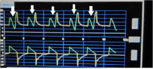 Hình 5: Mũi tên trắng cho thấy “flow asynchrony” trên biểu đồ pressure-time