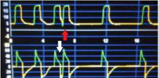 Xác định không đồng bộ bệnh nhân – máy thở bằng cách sử dụng phân tích biểu đồ dạng sóng