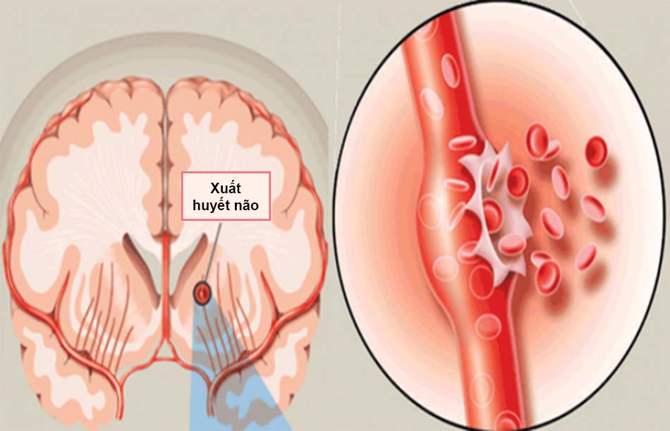 Xuất huyết não là gì?