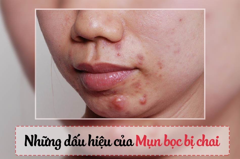 Những dấu hiệu của mụn bọc bị chai   