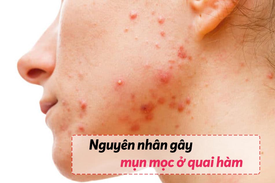 Nguyên nhân gây mụn ở quai hàm