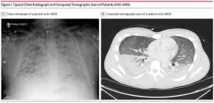 Các phát hiện X quang là đặc trưng của ARDS. A, X quang phổi thể hiện sự thâm nhiễm phổi 2 bên lan tỏa. B, chụp cắt lớp vi tính của ngực cho thấy sự phân bố các thâm nhiễm phổi 2 bên chủ yếu ở các vùng phụ thuộc (phần thấp), với phổi có thông khí ở các vùng không phụ thuộc (vùng trước ngực).