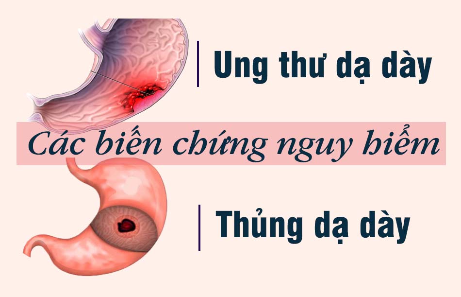 Biến chứng của viêm hang vị dạ dày