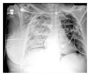 Hình 1: Phim X-quang ngực của bệnh nhân ARDS có biểu hiện tràn khí màng phổi thứ phát do rò phế quản – màng phổi.