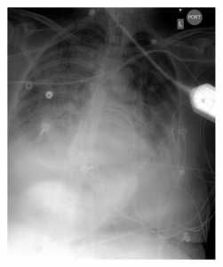 Hình 2: Phim X-quang ngực của bệnh nhân ARDS bị SAH độ 4.