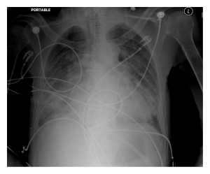 Hình 3: Phù phổi do quá tải thể tích do biến chứng của liệu pháp Triple H ở bệnh nhân Grade 4 SAH.
