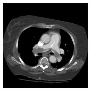 Figure 4: Thuyên tắc phổi hình yên ngựa (mũi tên màu trắng) trên bệnh nhân SAH.