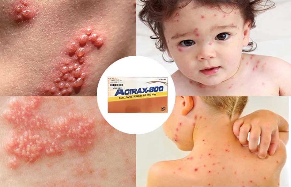 Thuốc Acirax điều trị một số bệnh do virus Herpes gây ra