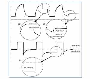 Hình 2: Lưu lượng thở ra, ngưng thì hít vào, và ngưng thì thở ra trong bẫy khí và auto-PEEP.
