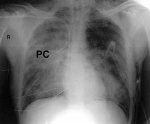 Hình 2: Phim x quang ngực cho thấy dập phổi (PC) lan rộng trên phổi phải
