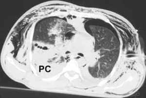 Hình 3: CT scan ngực cho thấy hình ảnh đông đặc là biểu hiện của dập phổi (PC) ở phổi phải. Tràn khí dưới da và tràn khí màng phổ cũng thấy ở 2 bên.