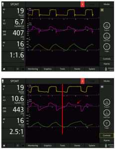 Hình 9: Bệnh nhân được thông khí với độ nhạy cảm kích hoạt hít vào: 2 l/phút, độ nhạy kích hoạt thở ra: 25%, độ dốc: 75 ms (trên cùng), ngay sau khi thay đổi ETS thành 10% (giữa; đường đỏ) và sau đó là các nhịp thở với ETS ở mức 10% (dưới). Lưu ý hít vào kéo dài với chu kỳ muộn trong nhịp thở đầu tiên sau khi cài đặt đã được thay đổi (mũi tên màu đỏ), và hiệu ứng kích hoạt sớm dẫn đến những nỗ lực không hiệu quả (mũi tên trắng).