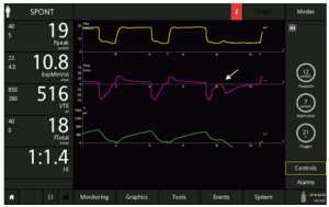 Hình 9: Bệnh nhân được thông khí với độ nhạy cảm kích hoạt hít vào: 2 l/phút, độ nhạy kích hoạt thở ra: 25%, độ dốc: 75 ms (trên cùng), ngay sau khi thay đổi ETS thành 10% (giữa; đường đỏ) và sau đó là các nhịp thở với ETS ở mức 10% (dưới). Lưu ý hít vào kéo dài với chu kỳ muộn trong nhịp thở đầu tiên sau khi cài đặt đã được thay đổi (mũi tên màu đỏ), và hiệu ứng kích hoạt sớm dẫn đến những nỗ lực không hiệu quả (mũi tên trắng). (tiếp)